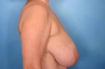 Breast Reduction Before Photo by Kent Hasen, MD; Naples, FL - Case 6852