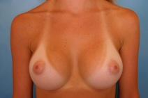 Breast Augmentation After Photo by Kent Hasen, MD; Naples, FL - Case 6854