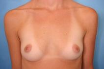 Breast Augmentation Before Photo by Kent Hasen, MD; Naples, FL - Case 6854