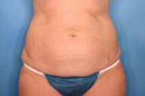 Tummy Tuck Before Photo by Kent Hasen, MD; Naples, FL - Case 6860