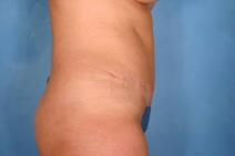 Tummy Tuck After Photo by Kent Hasen, MD; Naples, FL - Case 6860