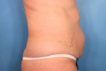 Tummy Tuck Before Photo by Kent Hasen, MD; Naples, FL - Case 6860
