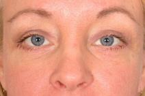 Eyelid Surgery After Photo by Kent Hasen, MD; Naples, FL - Case 6861