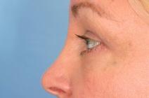 Eyelid Surgery After Photo by Kent Hasen, MD; Naples, FL - Case 6861