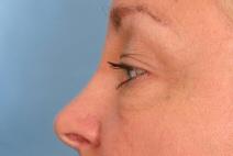 Eyelid Surgery Before Photo by Kent Hasen, MD; Naples, FL - Case 6861