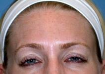 Botulinum Toxin After Photo by Kent Hasen, MD; Naples, FL - Case 6862