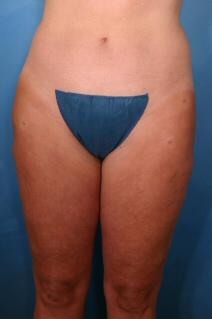 Liposuction After Photo by Kent Hasen, MD; Naples, FL - Case 6864