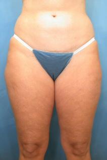 Liposuction Before Photo by Kent Hasen, MD; Naples, FL - Case 6864
