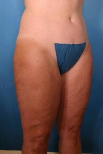 Liposuction After Photo by Kent Hasen, MD; Naples, FL - Case 6864