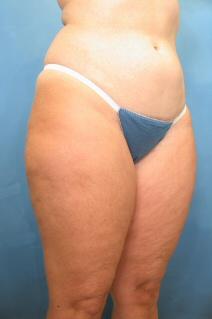 Liposuction Before Photo by Kent Hasen, MD; Naples, FL - Case 6864