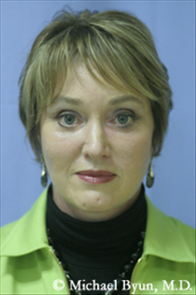 Facelift After Photo by Michael Byun, MD; Chicago, IL - Case 24321
