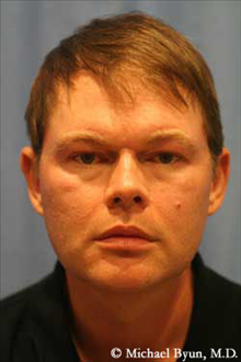 Facelift Before Photo by Michael Byun, MD; Chicago, IL - Case 24334
