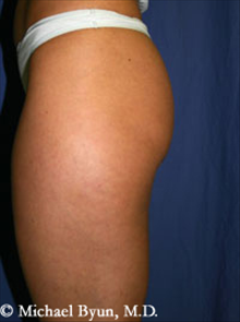 Buttock Implants Before Photo by Michael Byun, MD; Chicago, IL - Case 24347