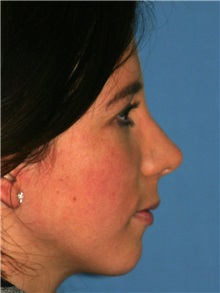 Rhinoplasty After Photo by Luis Bermudez, MD, FACS; Bogota, DC - Case 25451