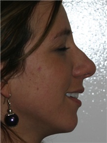 Rhinoplasty Before Photo by Luis Bermudez, MD, FACS; Bogota, DC - Case 25451