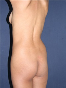 Buttock Implants Before Photo by Luis Bermudez, MD, FACS; Bogota, DC - Case 29501