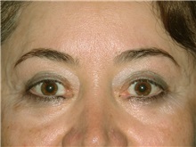 Eyelid Surgery After Photo by Luis Bermudez, MD, FACS; Bogota, DC - Case 29503