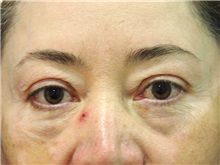 Eyelid Surgery Before Photo by Luis Bermudez, MD, FACS; Bogota, DC - Case 29503