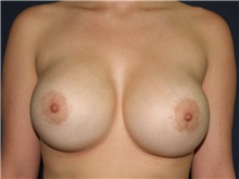 Breast Lift Before Photo by Luis Bermudez, MD, FACS; Bogota, DC - Case 29515