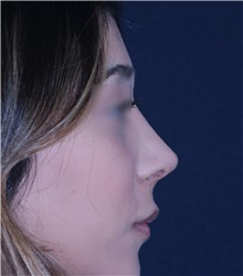 Rhinoplasty After Photo by Luis Bermudez, MD, FACS; Bogota, DC - Case 33997