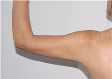 Liposuction After Photo by Luis Bermudez, MD, FACS; Bogota, DC - Case 33998