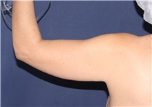 Liposuction Before Photo by Luis Bermudez, MD, FACS; Bogota, DC - Case 33998