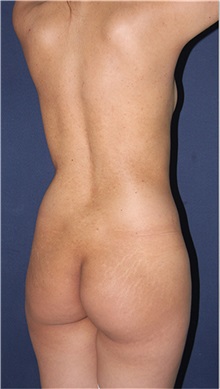 Buttock Implants Before Photo by Luis Bermudez, MD, FACS; Bogota, DC - Case 34013