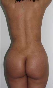 Buttock Implants After Photo by Luis Bermudez, MD, FACS; Bogota, DC - Case 34013