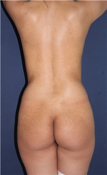 Buttock Implants Before Photo by Luis Bermudez, MD, FACS; Bogota, DC - Case 34013