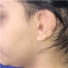 Ear Reconstruction Surgery After Photo by Luis Bermudez, MD, FACS; Bogota, DC - Case 37918