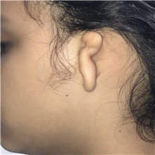 Ear Reconstruction Surgery Before Photo by Luis Bermudez, MD, FACS; Bogota, DC - Case 37918