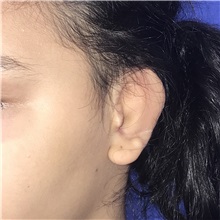 Ear Reconstruction Surgery After Photo by Luis Bermudez, MD, FACS; Bogota, DC - Case 37918