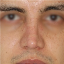 Rhinoplasty After Photo by Luis Bermudez, MD, FACS; Bogota, DC - Case 49555