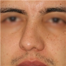 Rhinoplasty Before Photo by Luis Bermudez, MD, FACS; Bogota, DC - Case 49555