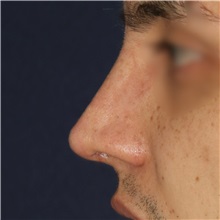 Rhinoplasty After Photo by Luis Bermudez, MD, FACS; Bogota, DC - Case 49555