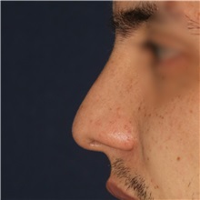 Rhinoplasty Before Photo by Luis Bermudez, MD, FACS; Bogota, DC - Case 49555