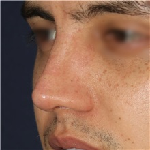 Rhinoplasty After Photo by Luis Bermudez, MD, FACS; Bogota, DC - Case 49555