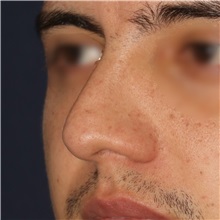 Rhinoplasty Before Photo by Luis Bermudez, MD, FACS; Bogota, DC - Case 49555