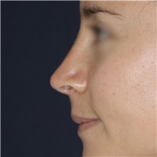 Rhinoplasty After Photo by Luis Bermudez, MD, FACS; Bogota, DC - Case 49560