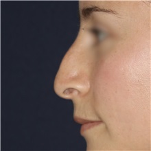 Rhinoplasty Before Photo by Luis Bermudez, MD, FACS; Bogota, DC - Case 49560