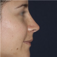 Rhinoplasty After Photo by Luis Bermudez, MD, FACS; Bogota, DC - Case 49560