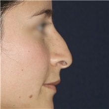 Rhinoplasty Before Photo by Luis Bermudez, MD, FACS; Bogota, DC - Case 49560