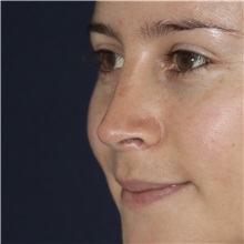 Rhinoplasty After Photo by Luis Bermudez, MD, FACS; Bogota, DC - Case 49560