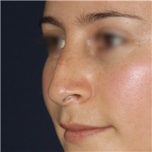 Rhinoplasty Before Photo by Luis Bermudez, MD, FACS; Bogota, DC - Case 49560