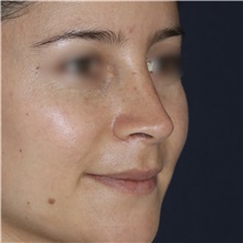 Rhinoplasty After Photo by Luis Bermudez, MD, FACS; Bogota, DC - Case 49560