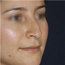 Rhinoplasty Before Photo by Luis Bermudez, MD, FACS; Bogota, DC - Case 49560