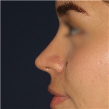 Rhinoplasty After Photo by Luis Bermudez, MD, FACS; Bogota, DC - Case 49563