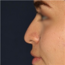 Rhinoplasty Before Photo by Luis Bermudez, MD, FACS; Bogota, DC - Case 49563