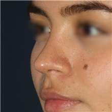 Rhinoplasty After Photo by Luis Bermudez, MD, FACS; Bogota, DC - Case 49563