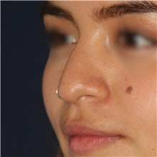 Rhinoplasty Before Photo by Luis Bermudez, MD, FACS; Bogota, DC - Case 49563